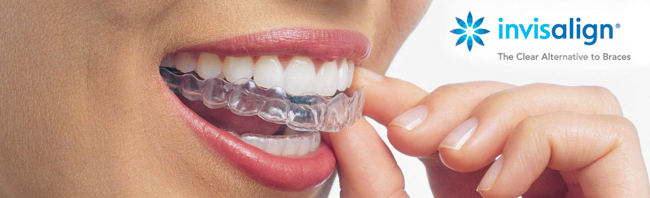 Invisalign Clear Aligners - Carter Orthodontics