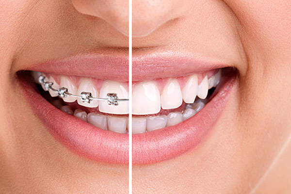 braces vs aligners