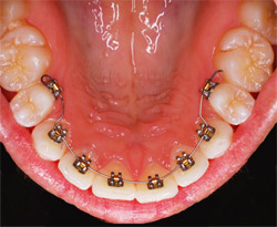 Are Metal Braces my best option to straighten my teeth?, Voss Dental -  Oral Surgery