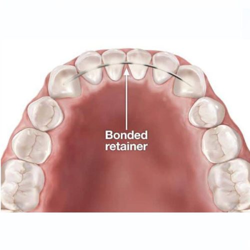 Retainer – Fixed Bonded Wire