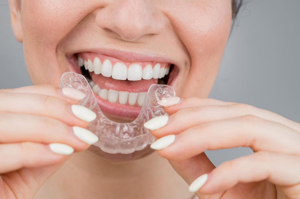 clear aligners